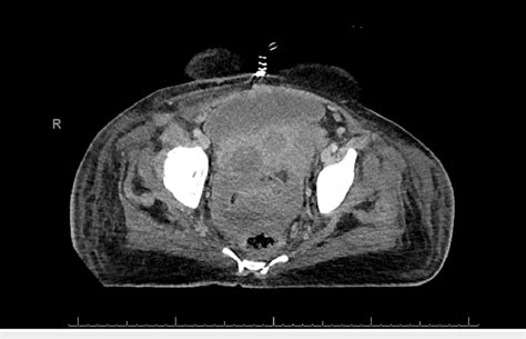 Ct Scan Shows A Large Pelvic Heterogeneous Soft Tissue Density Mass