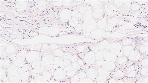 Spindle Cell Lipoma Atlas Of Pathology