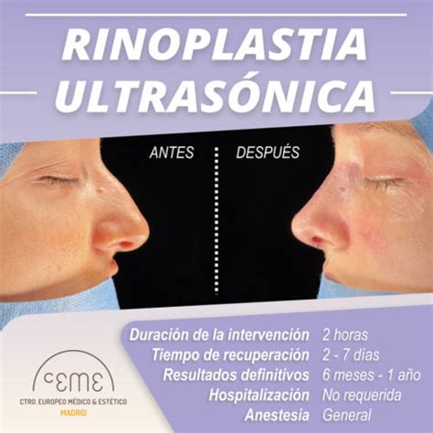 Rinoplastia ultrasónica antes y después en Centro Ceme