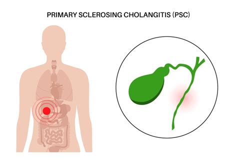 Primary Sclerosing Cholangitis Doctall Living