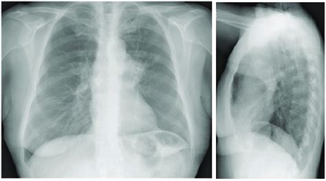 Chest X Ray Shows The Prominence Of Left Hilum And Lul Nodular Opacity Download Scientific