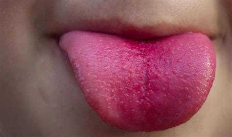 Vitamin B12 deficiency symptoms: A red beefy tongue could be warning ...