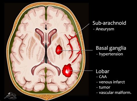 The Radiology Assistant Non Traumatic Intracranial Hemorrhage In 2022