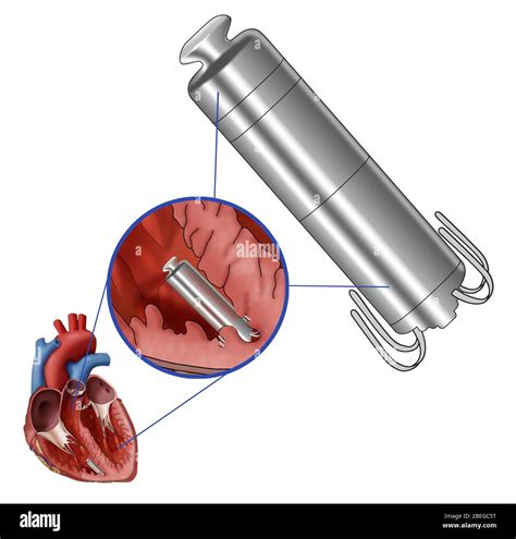 Leadless Pacemaker Illustration Stock Photo Alamy