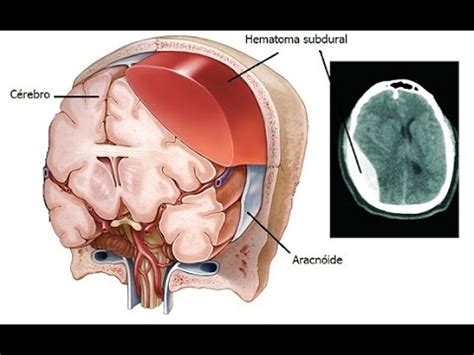 Wn Epidural Hematoma Subdural Hematoma Subarachnoid Hematoma