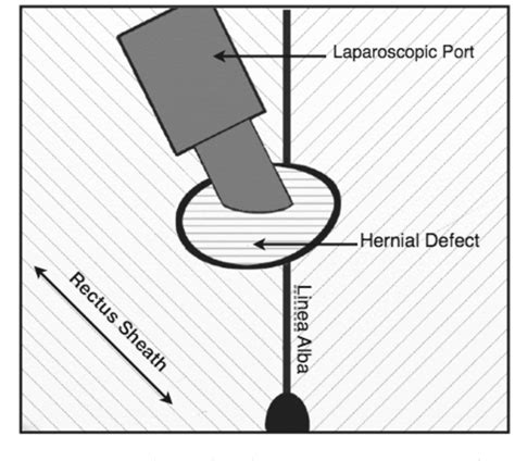 Figure 1 From Combined Laparoscopic Peritoneal Dialysis Catheter