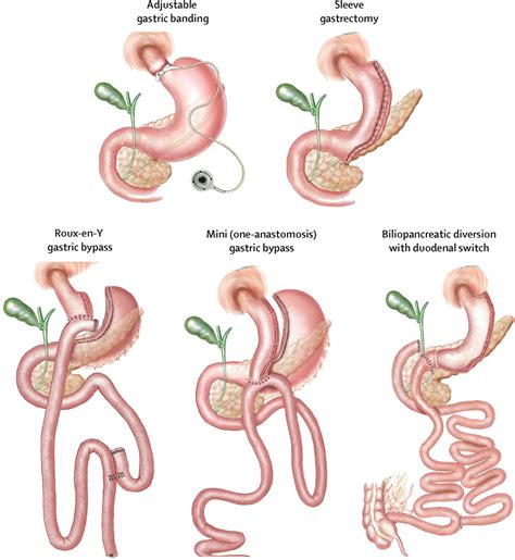 Bariatric Surgery in Turkey / Antalya- TURKEYOBESITYSURGERY