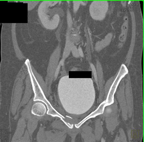 Pelvic Acetabular Fracture