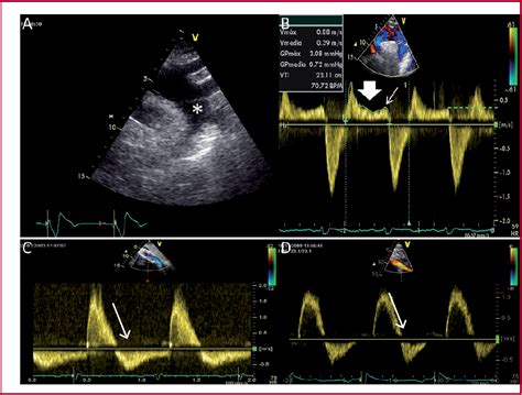 Figure 1 From Descending Aorta Diastolic Retrograde Flow Assessment For