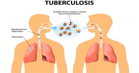 Enfermedades Infecciosas Causas Y Factores De Riesgo De La Tuberculosis