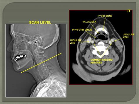 Ppt Ct Neck Powerpoint Presentation Id 2036160