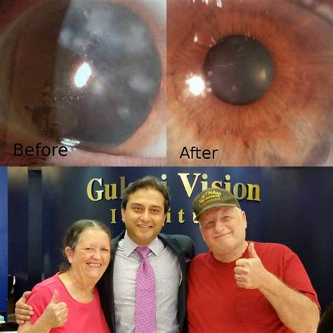 Complex Corneal Scars To 2020 Gulani Vision Institute