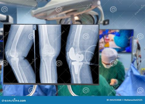 X Ray Of Knee Blurry Traumatology Orthopedic Surgery Hospital