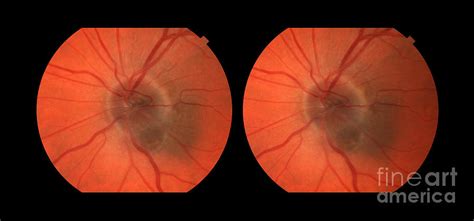 Melanoma Of The Optic Nerve Stereo Image Photograph by Paul Whitten ...