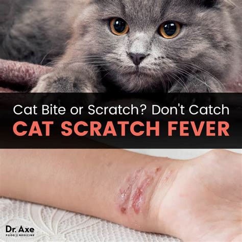 Cat Scratch Disease Rash