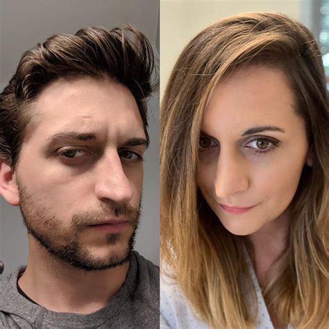 Mtf 20 Months Hrt 2 Months Post Opp Ffs Rtranstimelines