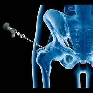 Hip Surgery Boston Total Hip Replacement Hip Labrum Reconstruction