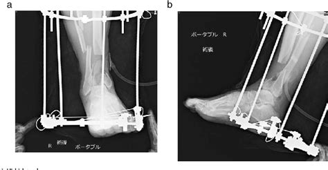 Figure 1 From Ankle Joint Reconstruction By Circular Frame External