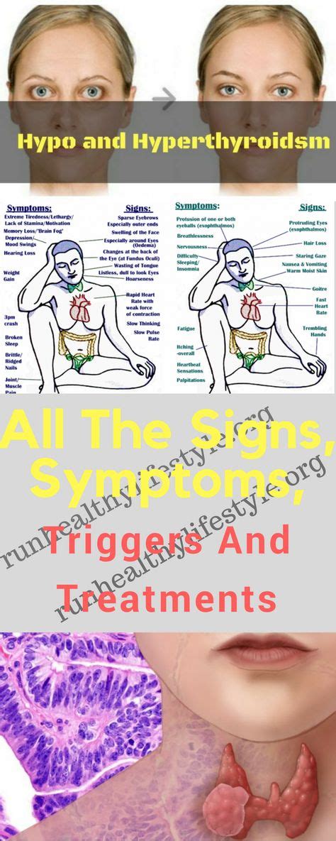 Hypo Vs Hyperthyroidism All The Signs Symptoms Triggers And