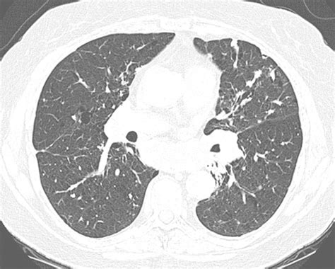 Case 182 Pulmonary Amyloidosis Radiology