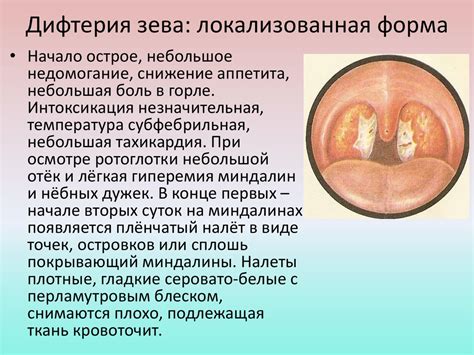 Оказание помощи детям при дифтерии, менингококковой инфекции ...