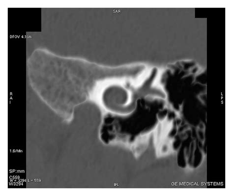 Hrct Scan Of Temporal Bone With Coronal Section Showing Cochlear