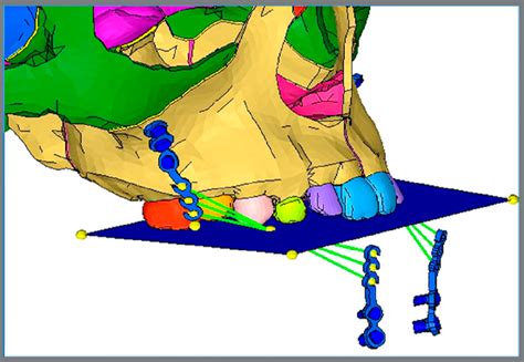 SciELO Brasil Effects Of Different Force Directions Of Intra Oral