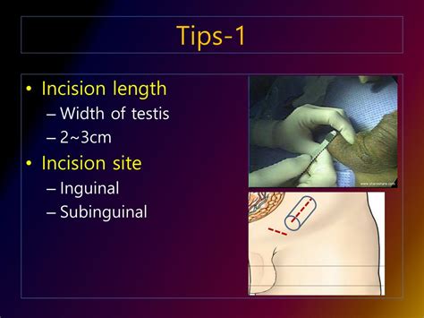 Ppt Tips And Tricks Scrotal Disease Varicocele Powerpoint Presentation Id2251797