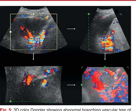 Figure 1 From Prenatal Diagnosis Of Morbidly Adherent Placenta With 2d