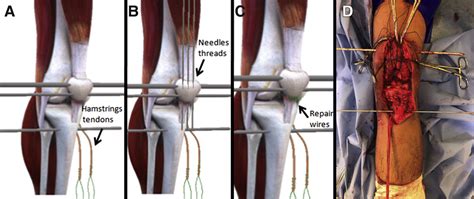 Surgical Treatment For Chronic Rupture Of The Patellar Tendon Performed