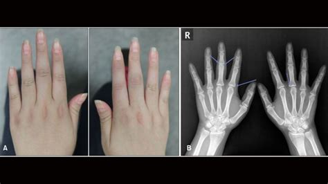 Psoriatic Arthritis Radiology: Types, Features, and Pictures