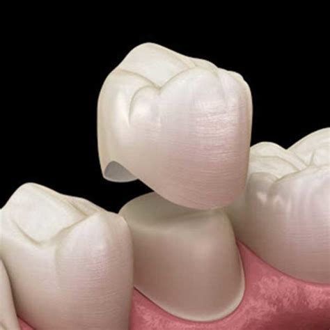 Anveli Dental Dental Crown