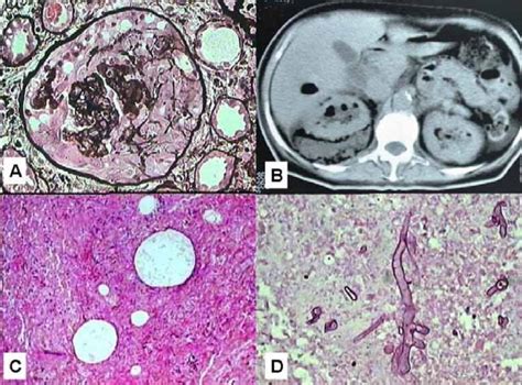 A Silver Staining Of Renal Biopsy Showing A Cellular Crescent In One