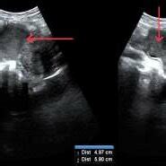 Ultrasound showing right endometriotic cyst (red arrows) | Download ...