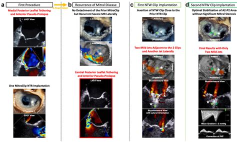 Percutaneous Transcatheter Edge To Edge Mitral Valve Repair With