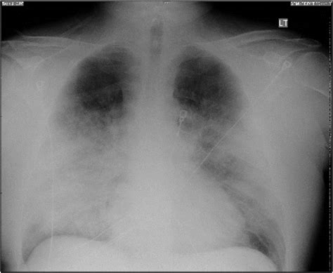 Chest X Ray Posterior Anterior Projection Revealed Bilateral Diffuse