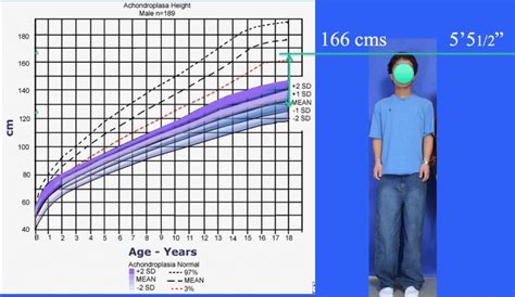 Achondroplasia Vs Normal