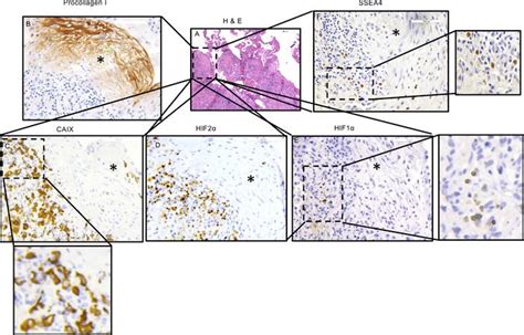 Jci Insight Hypoxia Enhances Ipf Mesenchymal Progenitor Cell