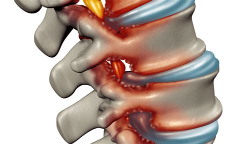 Foraminal Stenosis - Hooman Melamed, MD What is foraminal narrowing?