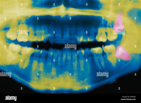 WISDOM TOOTH, X RAY Stock Photo - Alamy