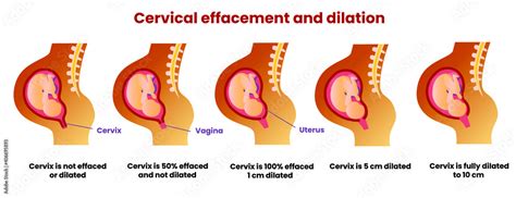 Cervical Effacement What Is It Measurement And Significance E