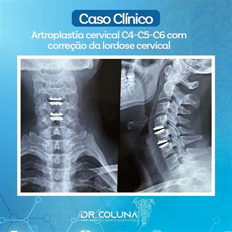 Artroplastia Cervical C C C Corre O Da Lordose Cervical