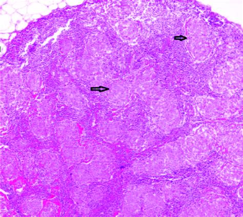 Confluent Non Necrotizing Granuloma Structures Filling The Lymph Node