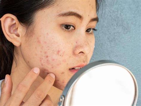 Everything To Know About Cystic Acne And How To Treat It Femina In