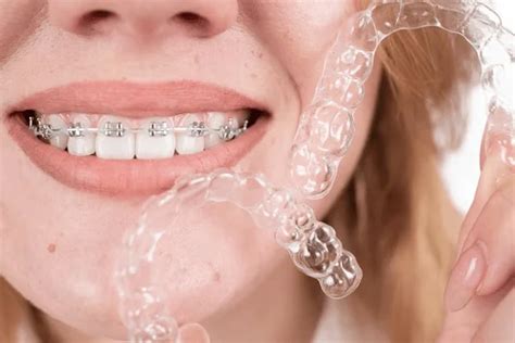 Descubre Todo Sobre La Ortodoncia Con Brackets Precios Antes Y