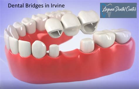 Irvine Dental Bridges Procedure Cost Who Its For Longevity