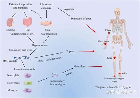 全面认识痛风：症状、风险因素、发病机理及管理 知乎