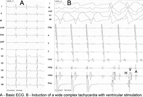 Wide Complex Tachycardia An Unusual Presentation Heart Rhythm