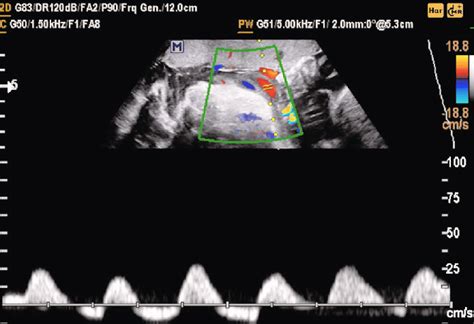 Reverse Flow In Umbilical Artery Shown In Ultrasonographic Examination