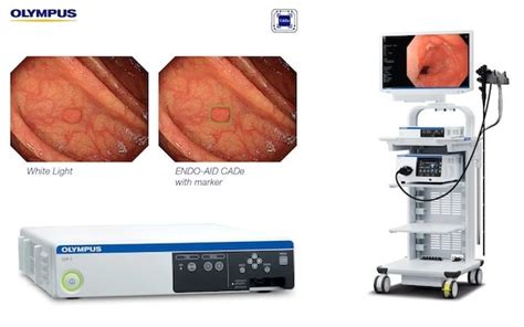 Aiによる診断支援アプリを搭載した内視鏡cadプラットフォームを発売：医療機器ニュース Monoist
